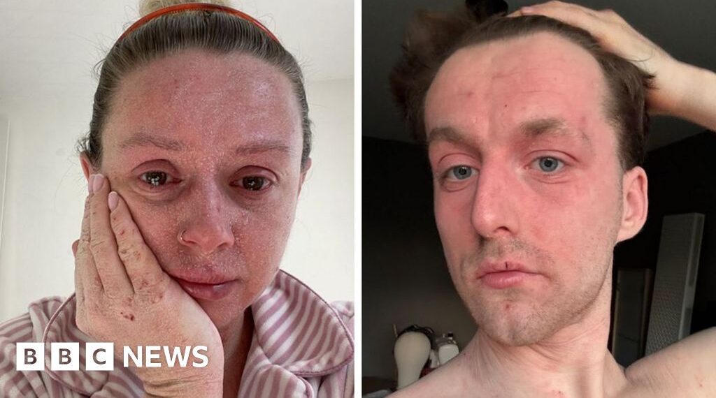 'Our skin is falling off and no-one can tell us why '