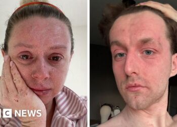 'Our skin is falling off and no-one can tell us why '