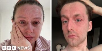 'Our skin is falling off and no-one can tell us why '
