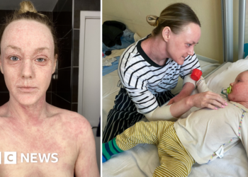 Hundreds contact BBC about mystery skin condition 'hell' - but doctors can't agree it exists