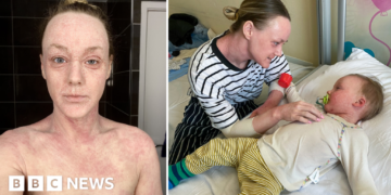 Hundreds contact BBC about mystery skin condition 'hell' - but doctors can't agree it exists