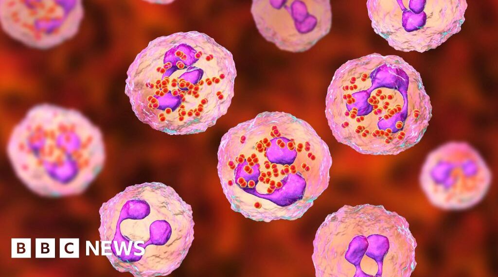 One dead and two ill after meningitis cases in Reading